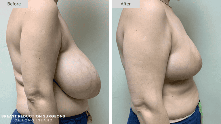 Breast Reduction Long Island Before and After Side Patient 9