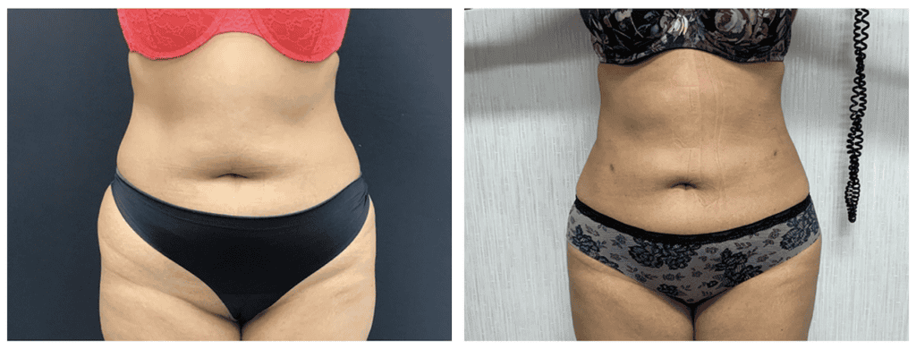 Liposuction Surgery