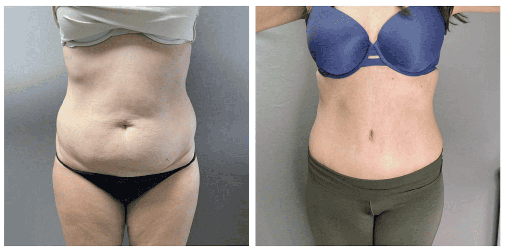 Tummy Tuck Surgery