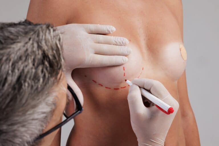 Wise Pattern Breast Reduction Surgery