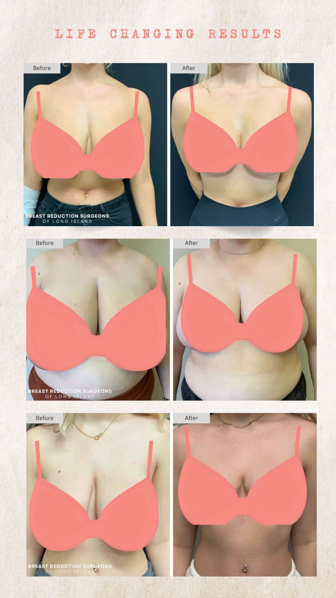 Breast Reduction Before and After Photos