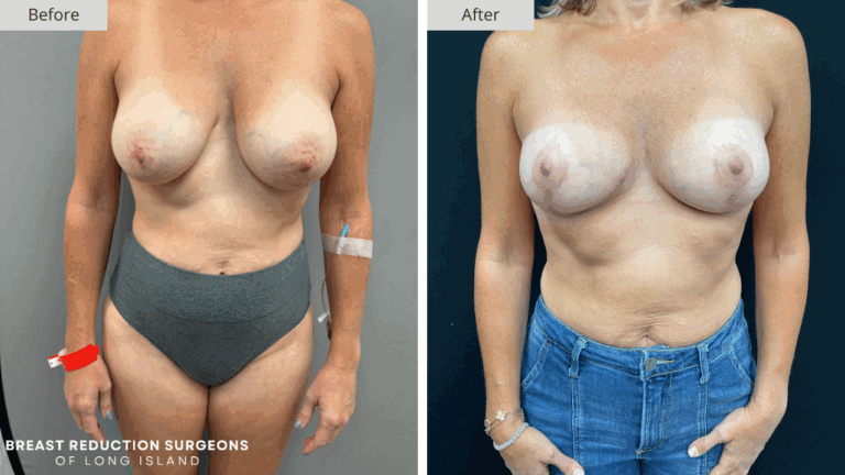 Breast Reduction Long Island Before & After Patient 113a