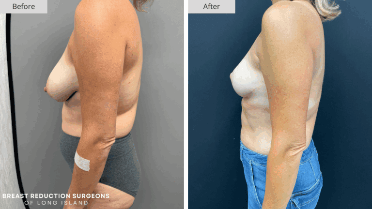 Breast Reduction Long Island Before & After Patient 113b