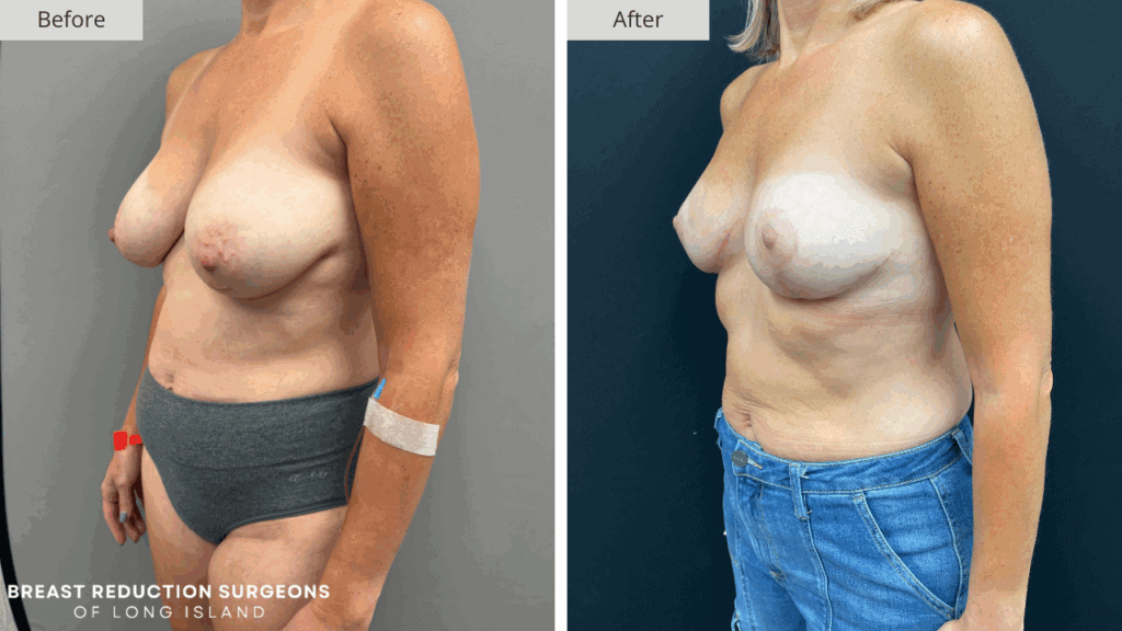 Breast Reduction Long Island Before & After Patient 113c