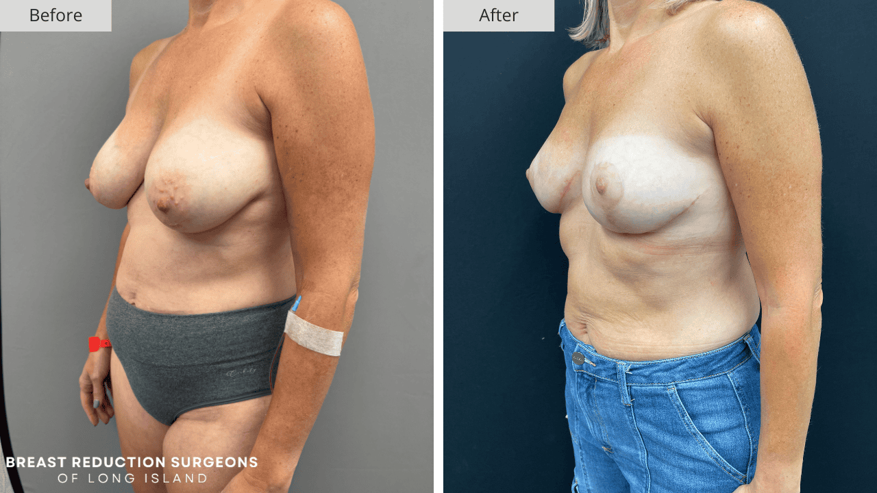 Breast Reduction Long Island Before & After Patient 113c