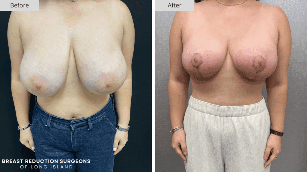 Breast Reduction Long Island Before & After Patient 114a