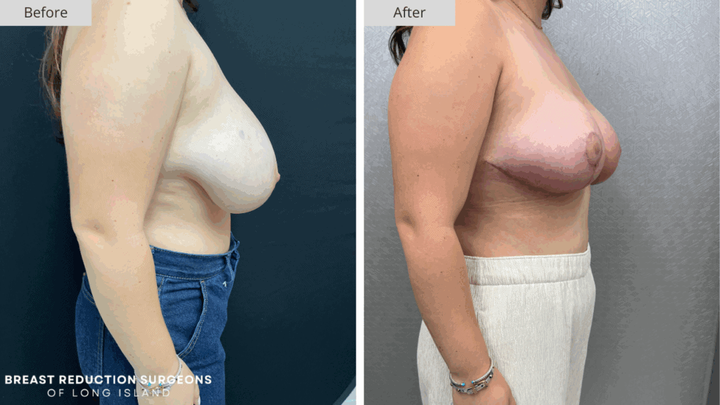 Breast Reduction Long Island Before & After Patient 114c