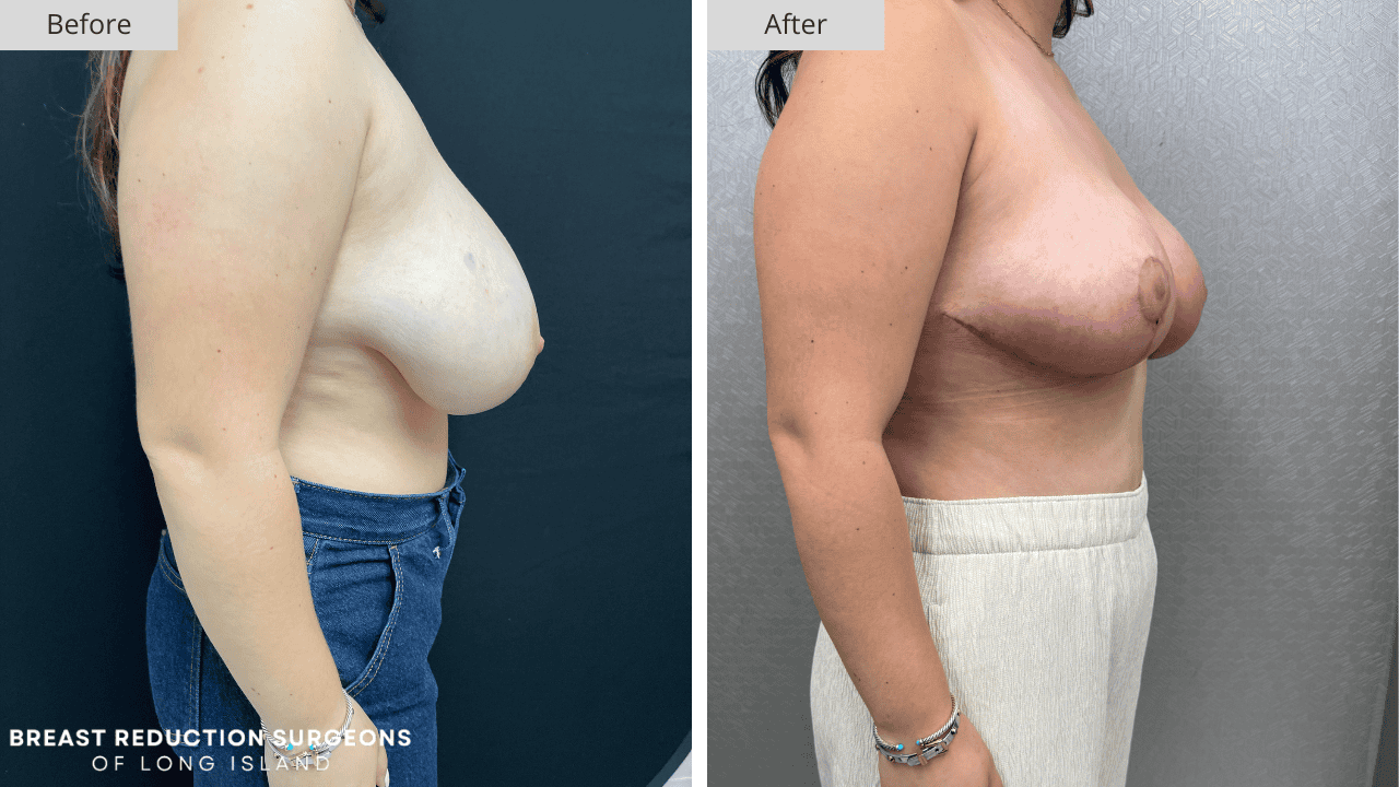 Breast Reduction Long Island Before & After Patient 114c