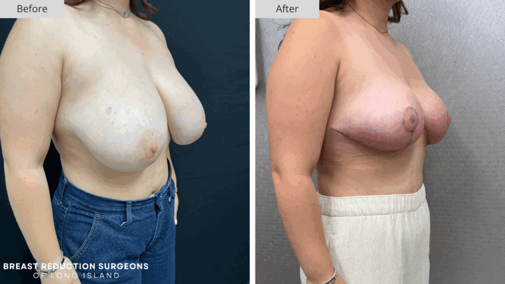 Breast Reduction Long Island Before & After Patient 114b