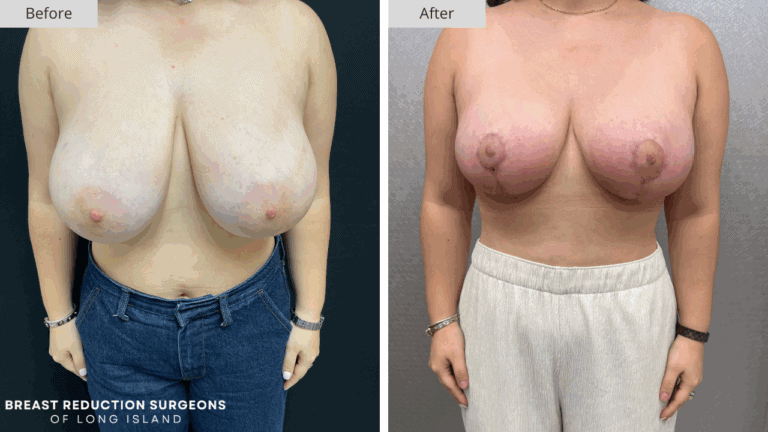 Breast Reduction Long Island Before & After Patient 114a