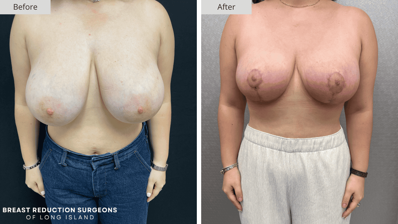 Breast Reduction Long Island Before & After Patient 114a