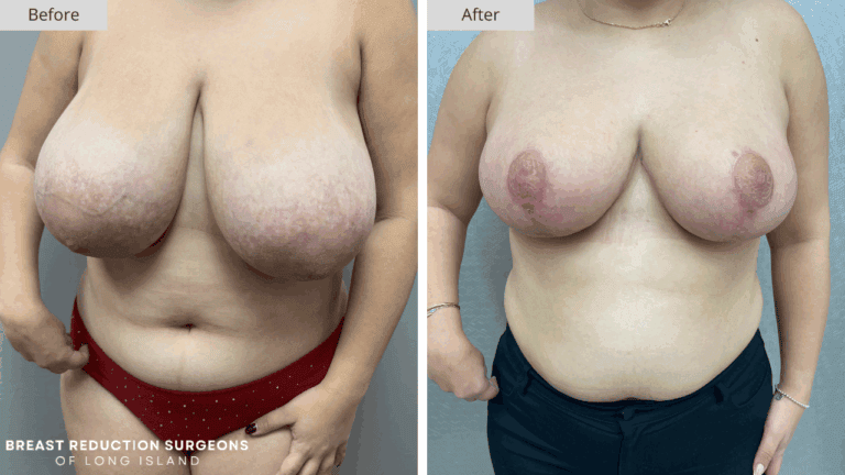 Breast Reduction Long Island Before & After Patient 115a