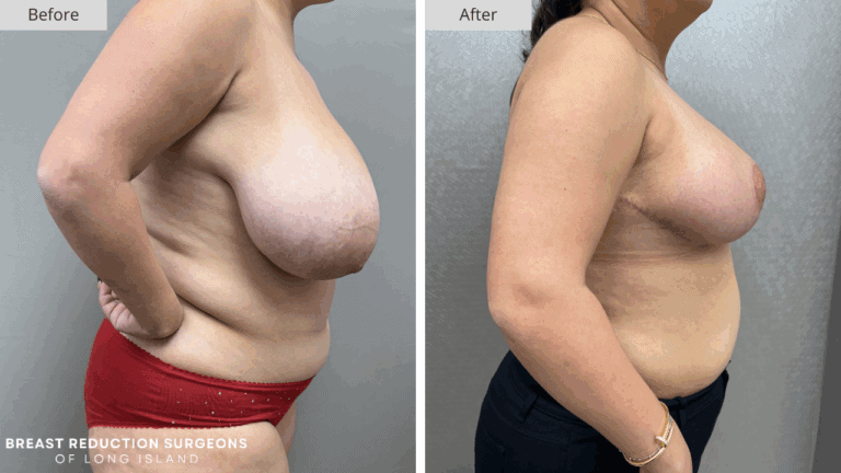 Breast Reduction Long Island Before & After Patient 115b
