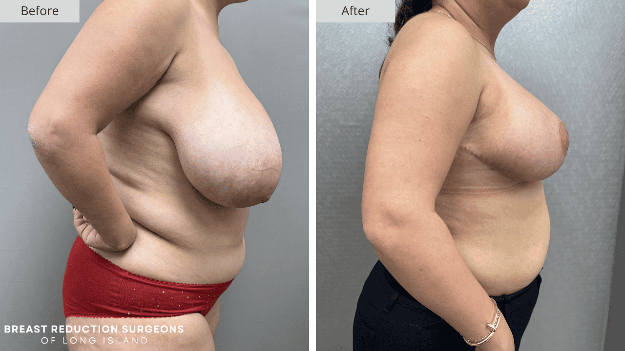 Breast Reduction Long Island Before & After Patient 115b
