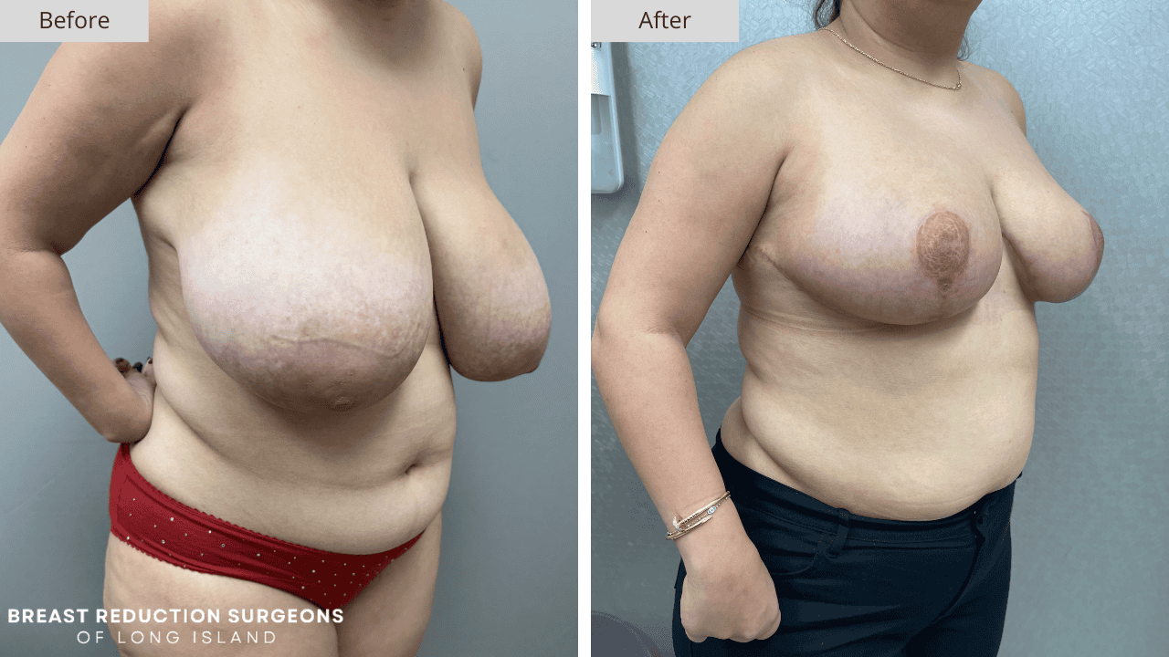 Breast Reduction Long Island Before & After Patient 115c