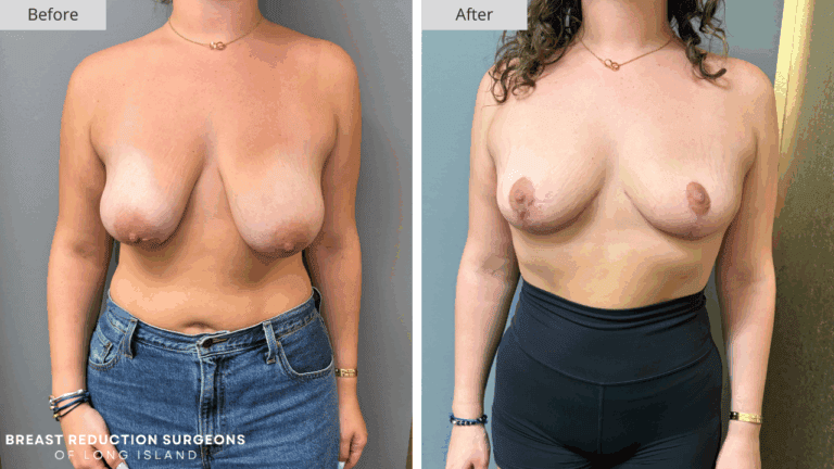 Breast Reduction Long Island Before & After Patient 116a