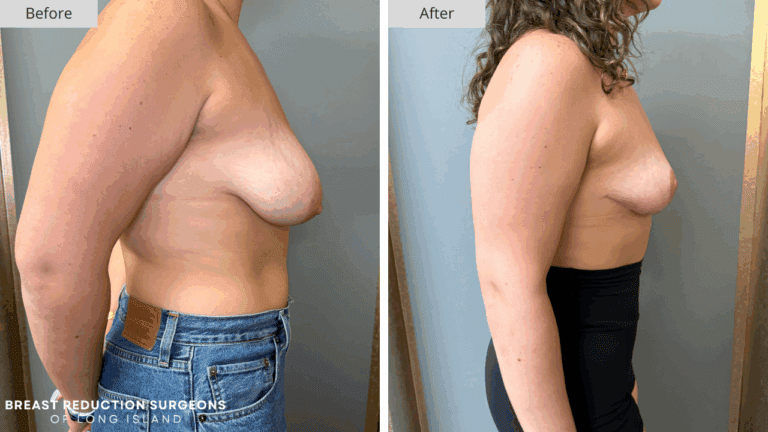 Breast Reduction Long Island Before & After Patient 116b