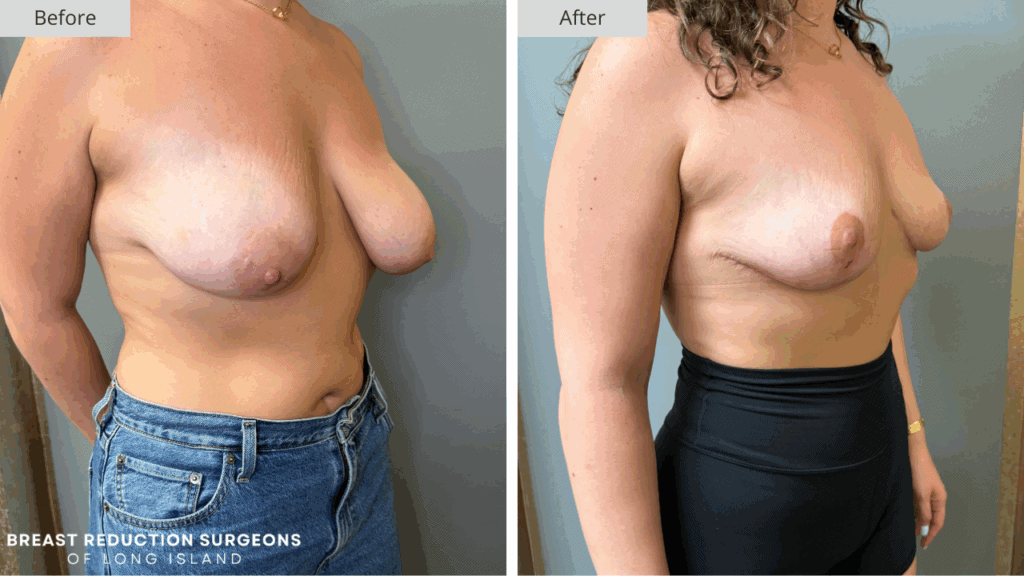 Breast Reduction Long Island Before & After Patient 116c