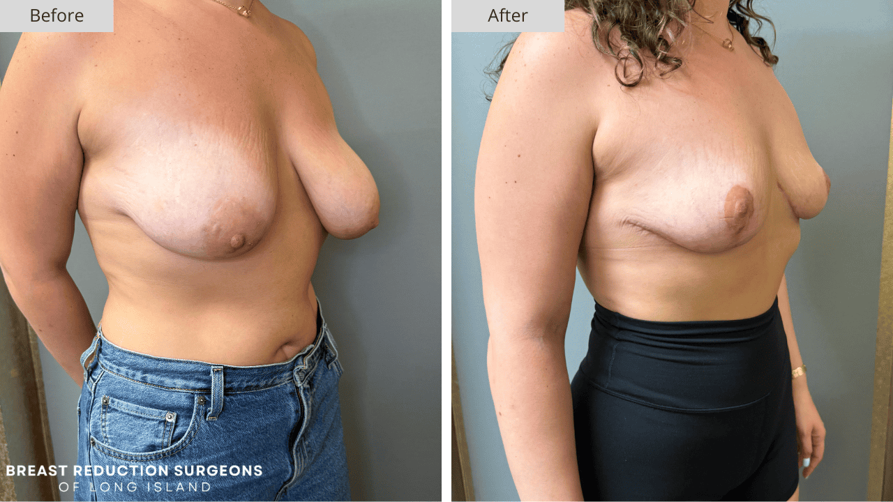 Breast Reduction Long Island Before & After Patient 116c