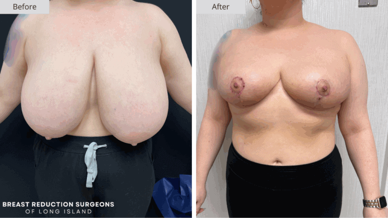 Breast Reduction Long Island Before & After Patient 117a