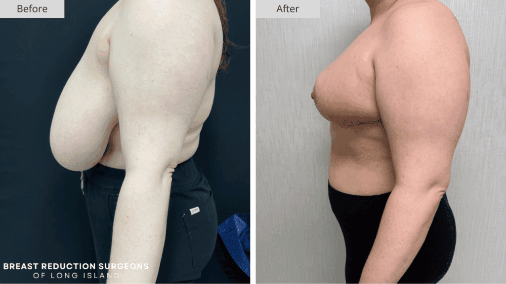 Breast Reduction Long Island Before & After Patient 117b