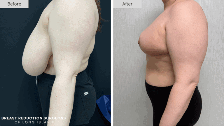 Breast Reduction Long Island Before & After Patient 117b