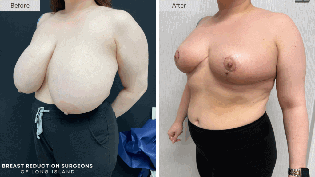 Breast Reduction Long Island Before & After Patient 117c
