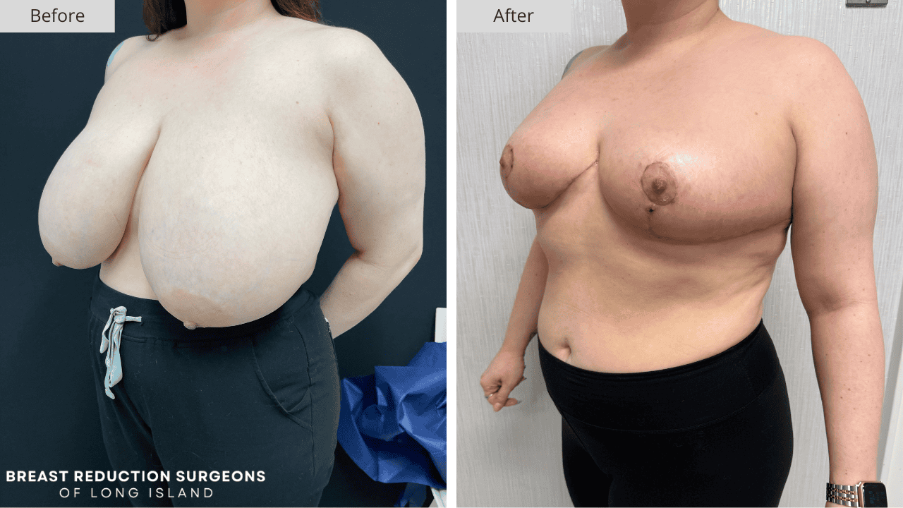 Breast Reduction Long Island Before & After Patient 117c