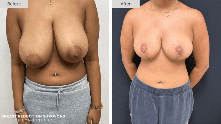Breast Reduction Long Island Before & After Patient 118a