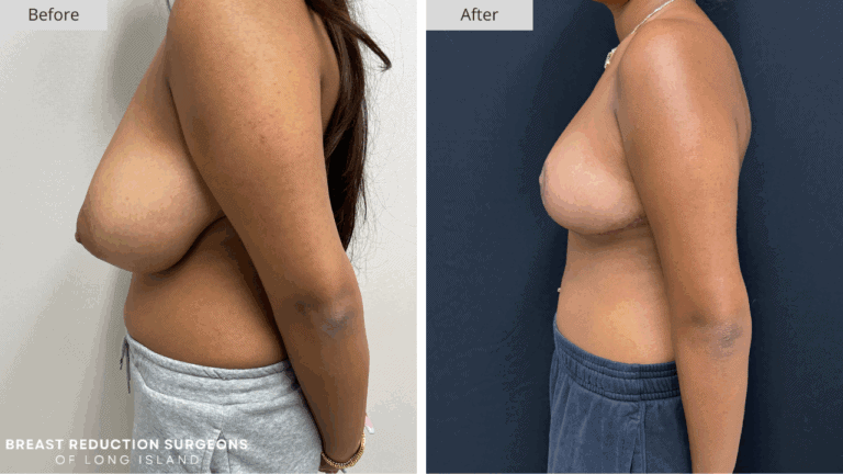 Breast Reduction Long Island Before & After Patient 118b