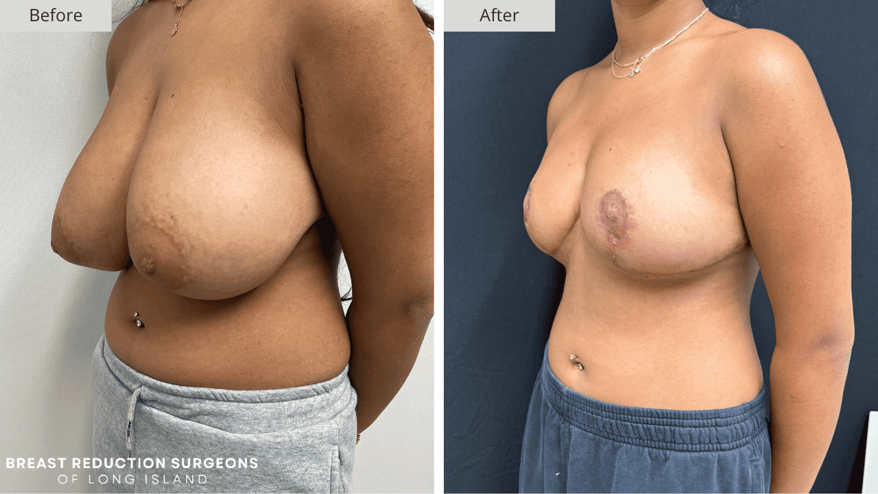 Breast Reduction Long Island Before & After Patient 118c