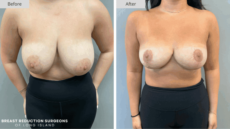 Breast Reduction Long Island Before & After Patient 119a