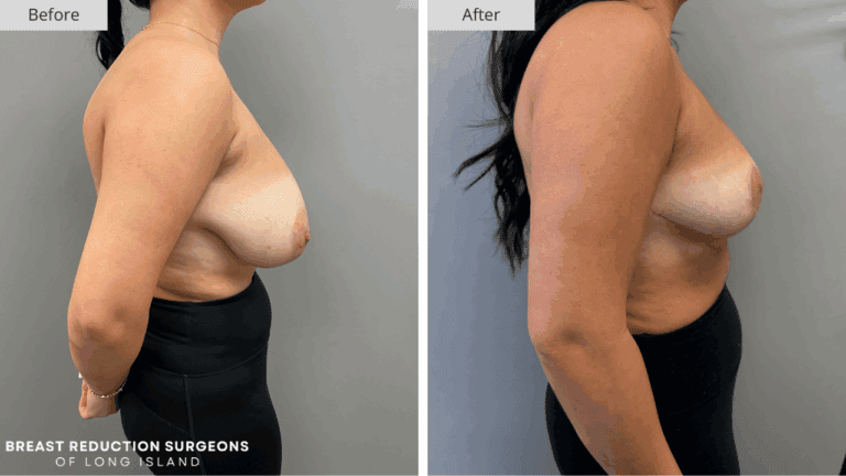 Breast Reduction Long Island Before & After Patient 119b