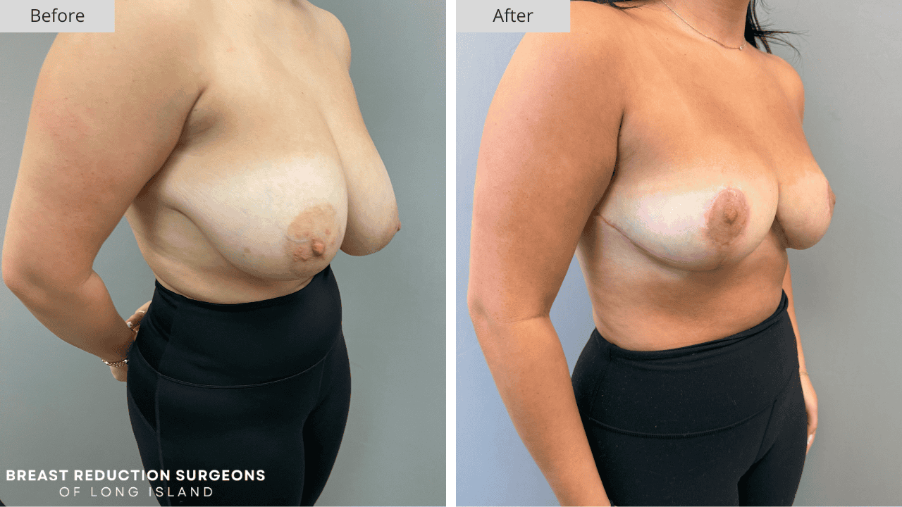 Breast Reduction Long Island Before & After Patient 119c