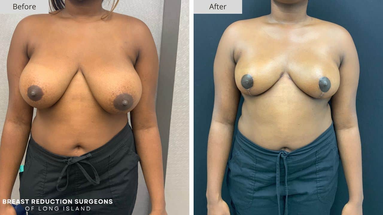 Breast Reduction Long Island Before & After Patient 120a