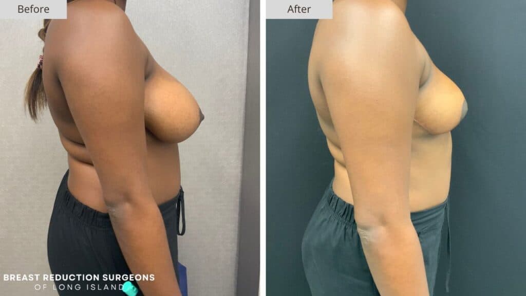 Breast Reduction Long Island Before & After Patient 120b