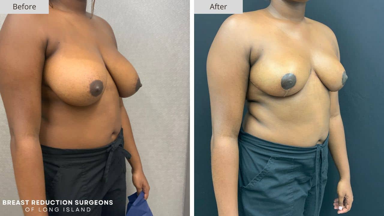 Breast Reduction Long Island Before & After Patient 120c