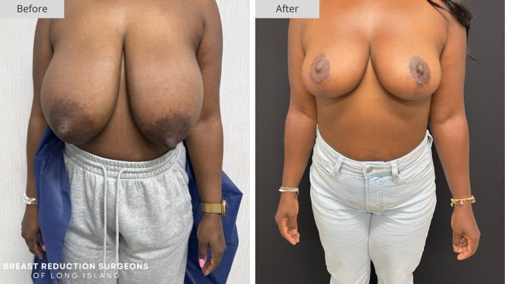 Breast Reduction Long Island Before & After Patient 121a
