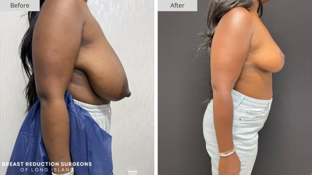Breast Reduction Long Island Before & After Patient 121b