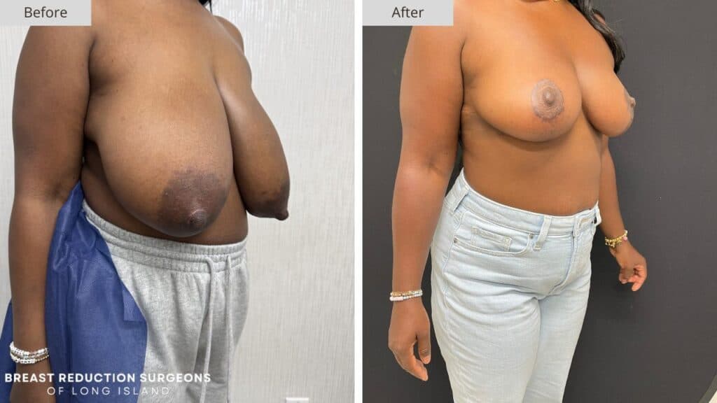 Breast Reduction Long Island Before & After Patient 121c