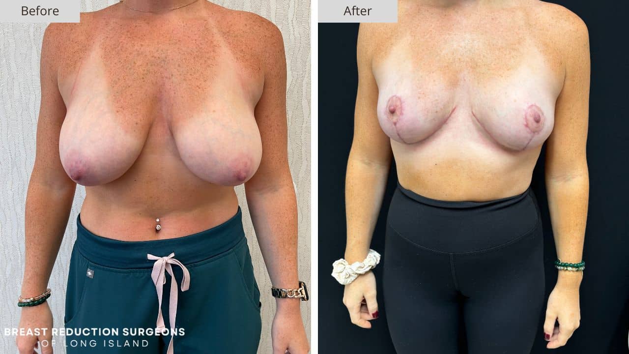 Breast Reduction Long Island Before & After Patient 122a