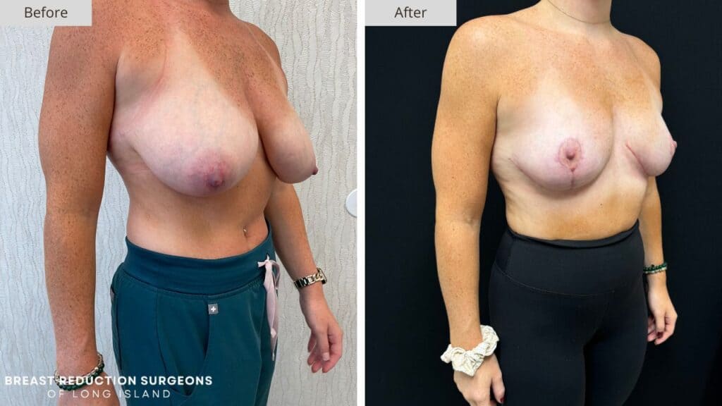 Breast Reduction Long Island Before & After Patient 122b