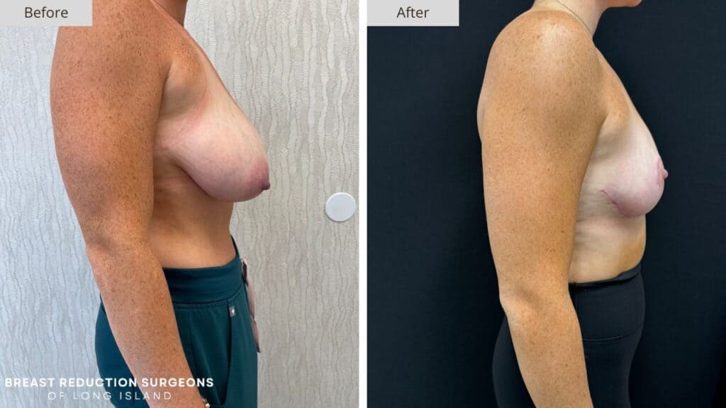 Breast Reduction Long Island Before & After Patient 122c