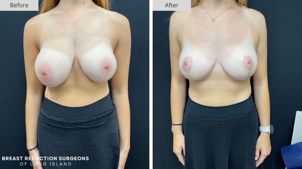 Breast Reduction Long Island Before & After Patient 123a