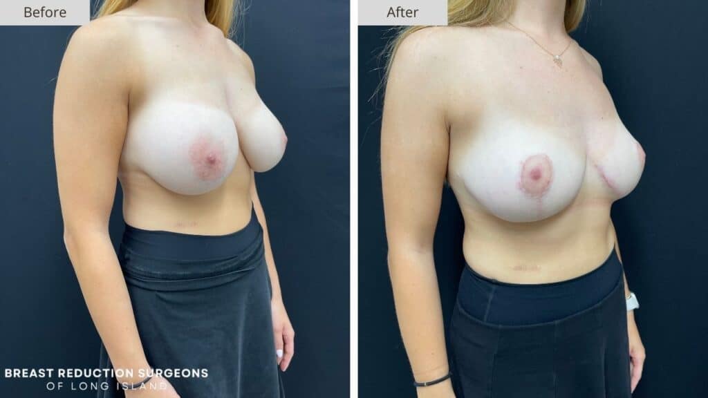 Breast Reduction Long Island Before & After Patient 123b