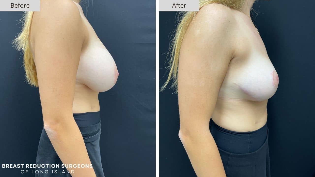 Breast Reduction Long Island Before & After Patient 123c