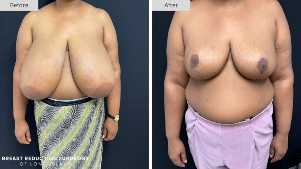 Breast Reduction Long Island Before & After Patient 124a