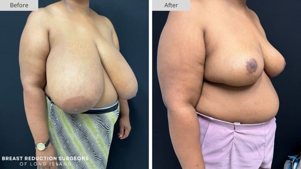 Breast Reduction Long Island Before & After Patient 124b