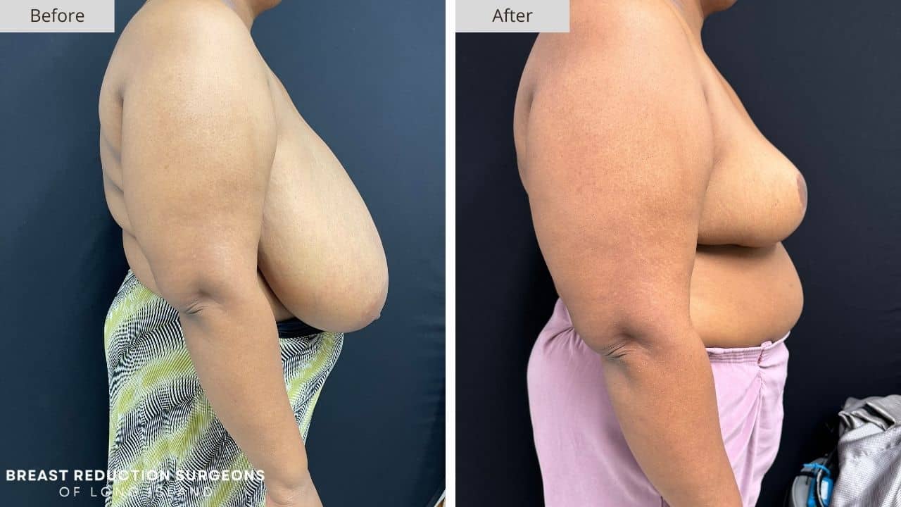 Breast Reduction Long Island Before & After Patient 124c