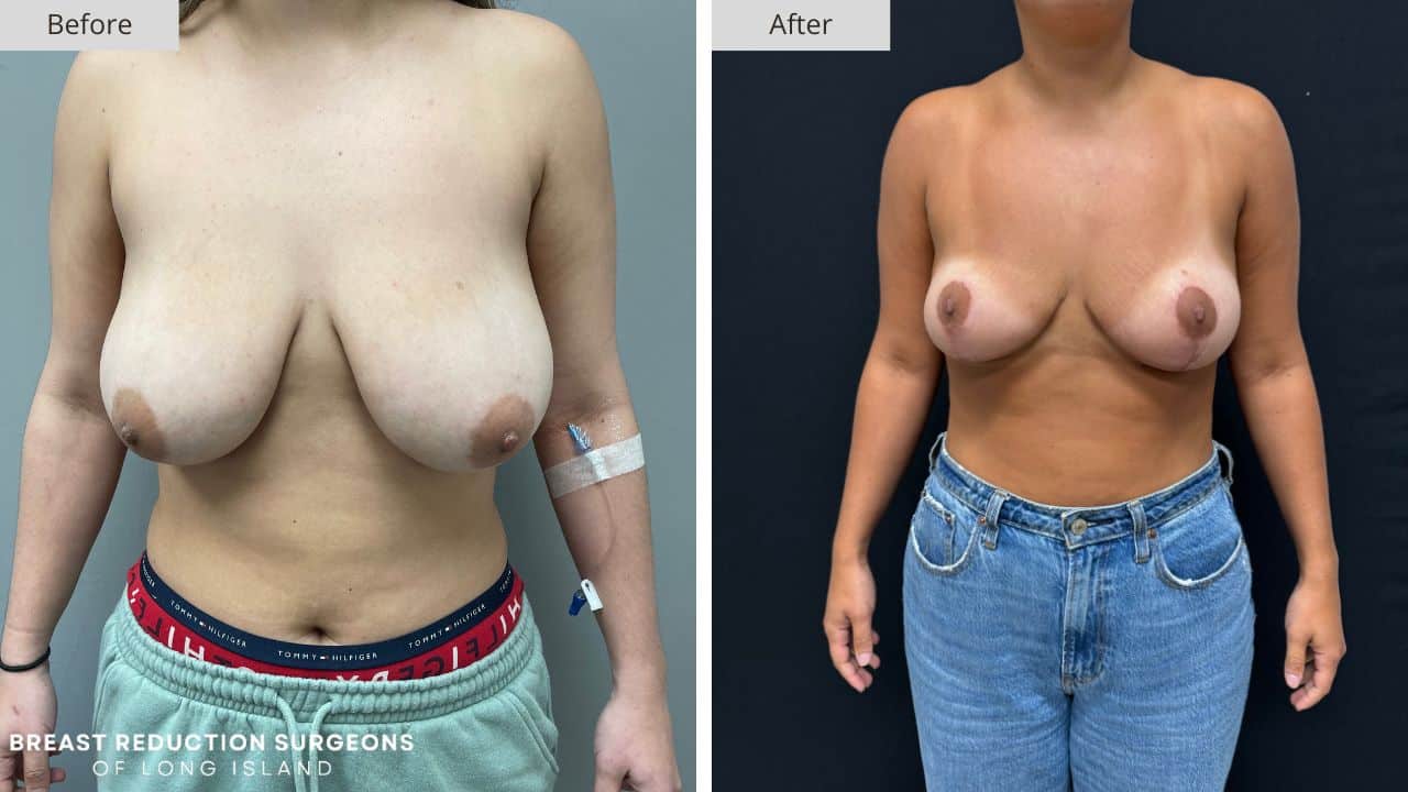 Breast Reduction Long Island Before & After Patient 125a